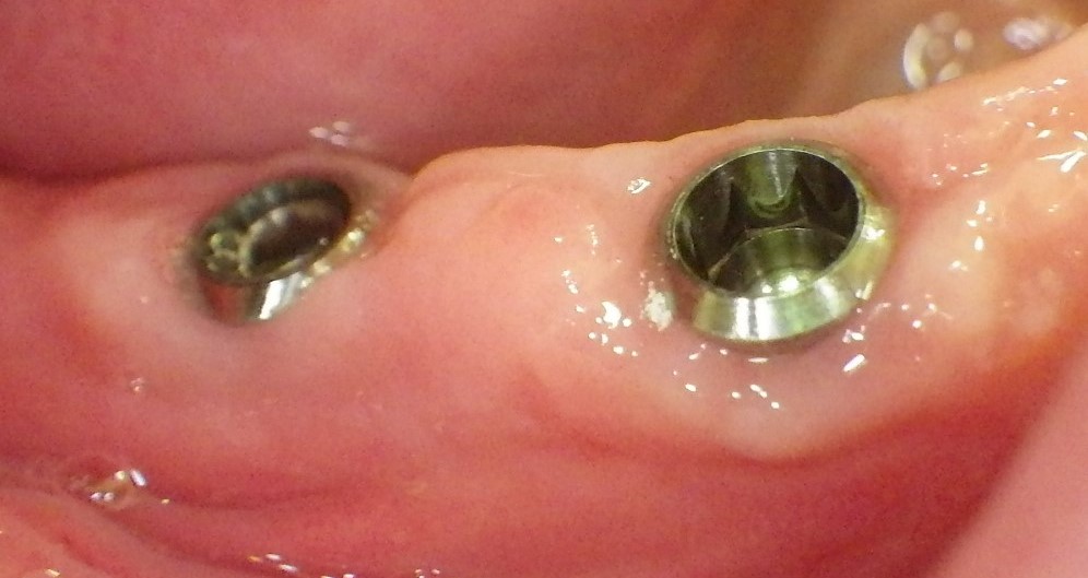 Implantate auf Zahnfleischniveau