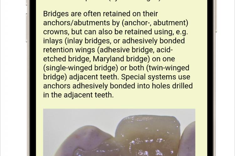 Dental-Dictionary.eu focus text e.g. bridges